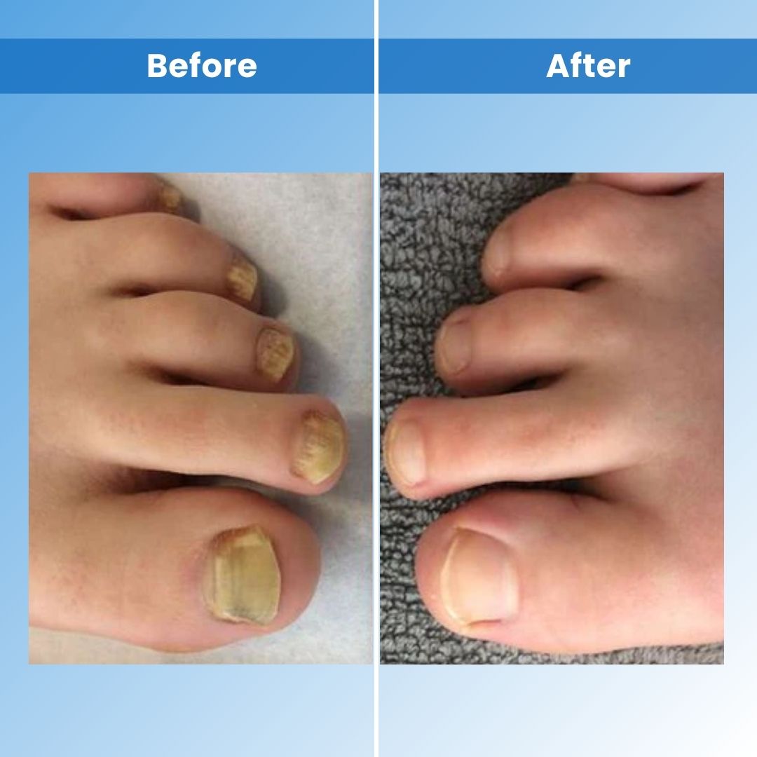 NailCure Pro™ - Laser Nail Treatment Device