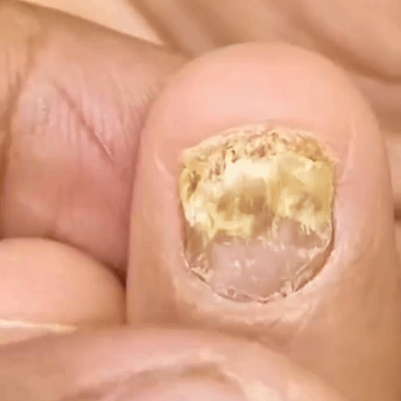 Tired of Stubborn Nail Fungus Problem