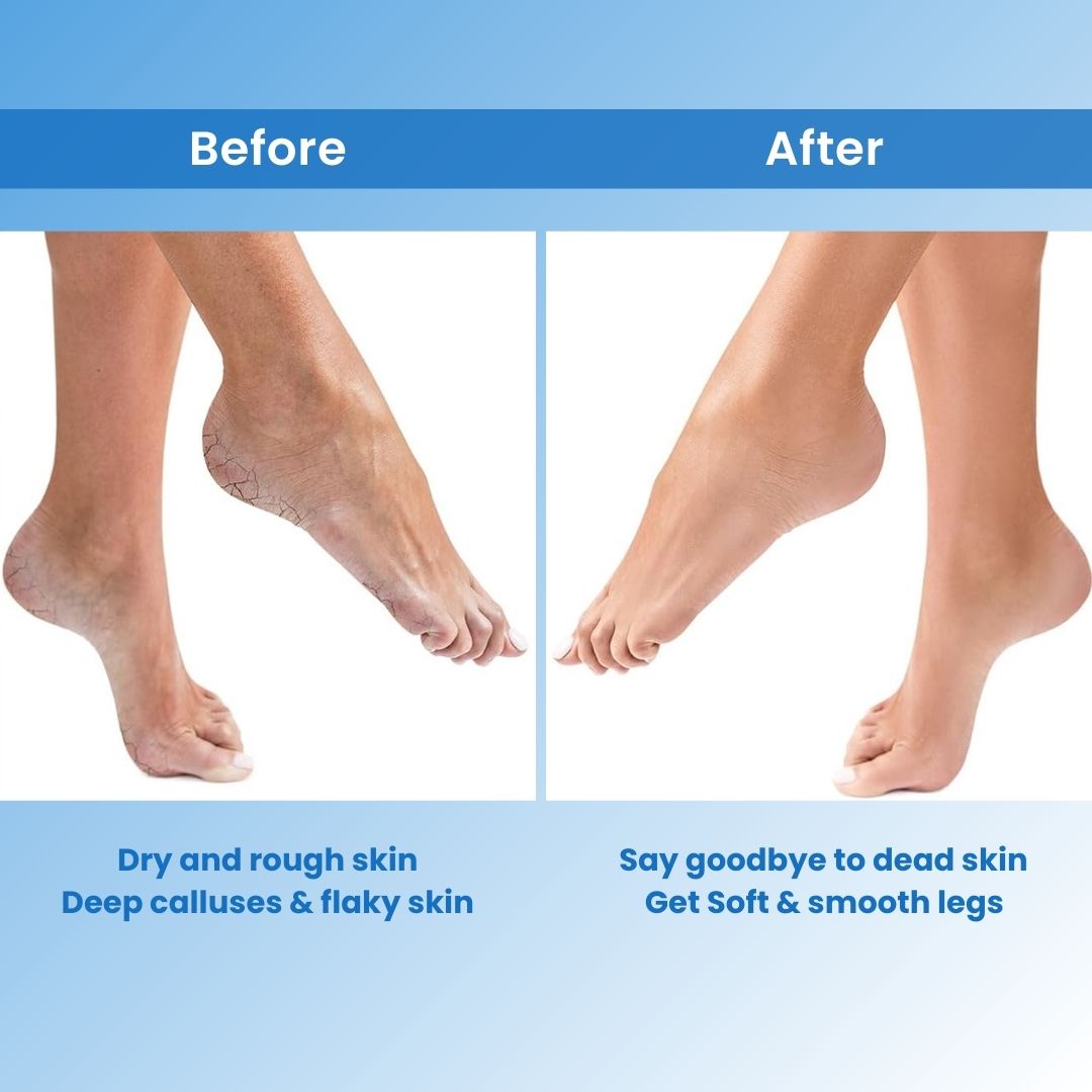 CallusCut™ - Electric Foot Callus Remover