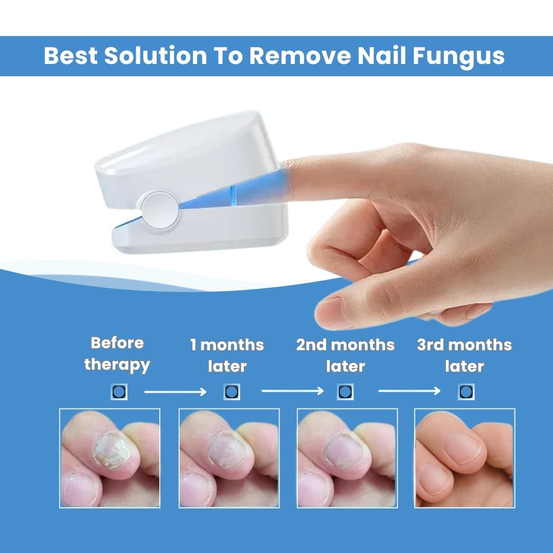 FungeeFree™ - Nail Fungus Laser