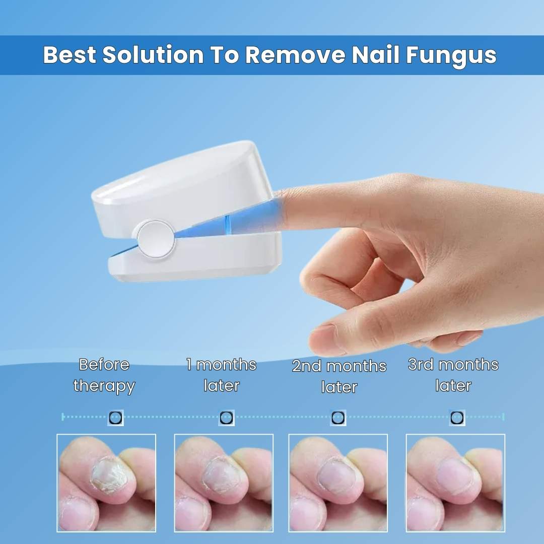 FungeeFree™ - Nail Fungus Laser