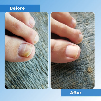 FungeeFree™ - Nail Fungus Laser