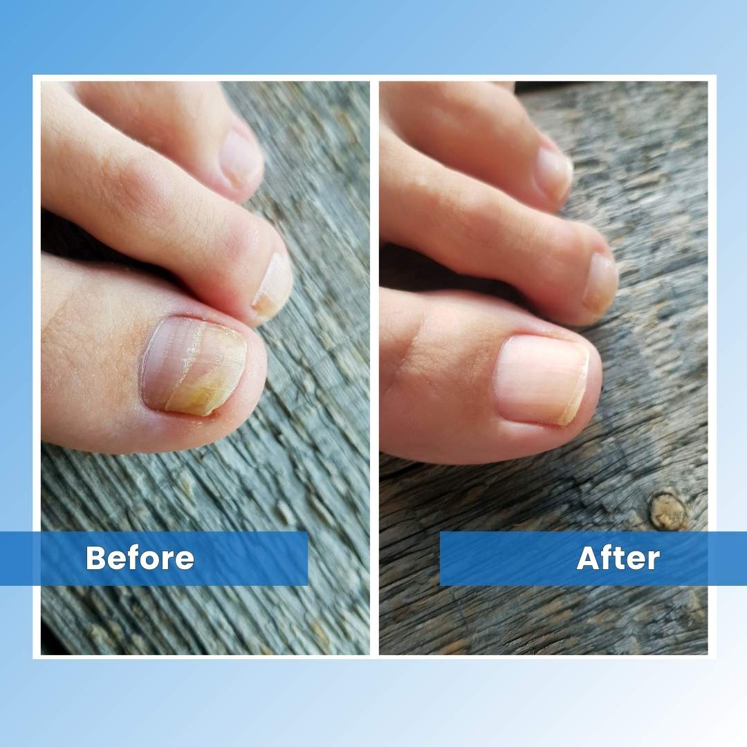 FungeeFree™ - Nail Fungus Laser